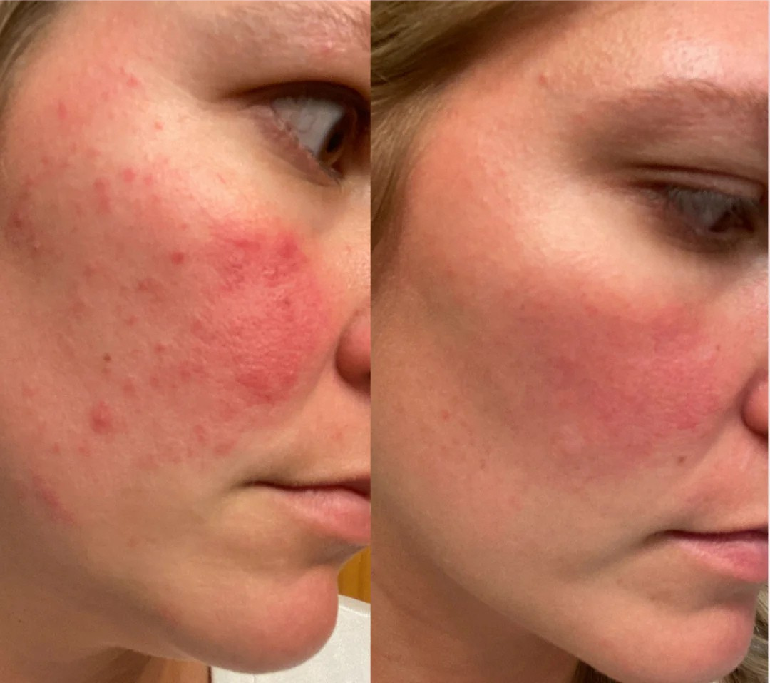 HydroBeauty Boost | Duo Sheet Mask Set | 1+1 FREE